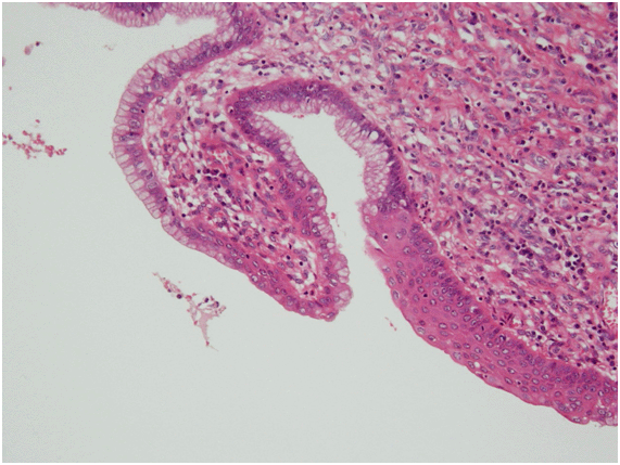 Squamous cell metaplasia